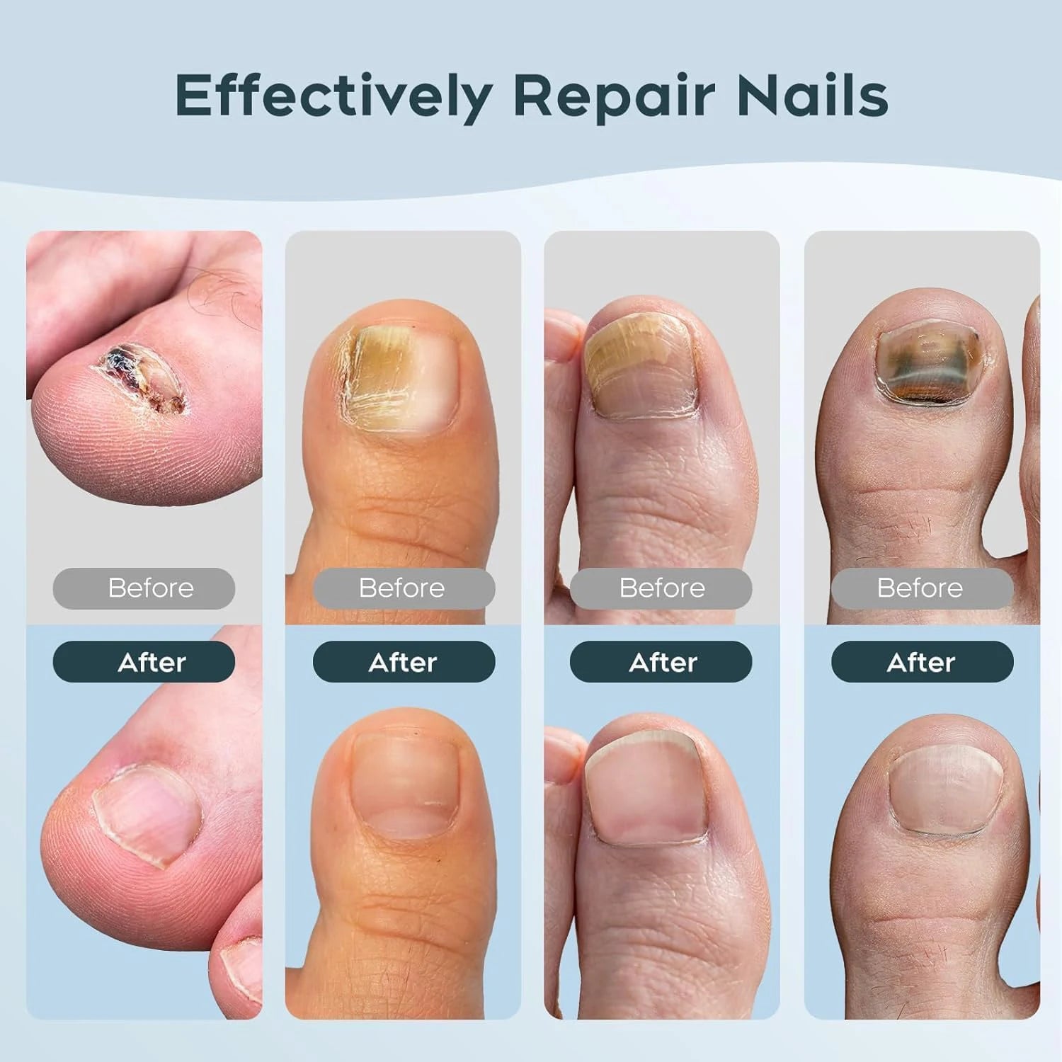 New Household Fungal Nail Laser Device – Toenail Fungus Repair & Nail Care Tool