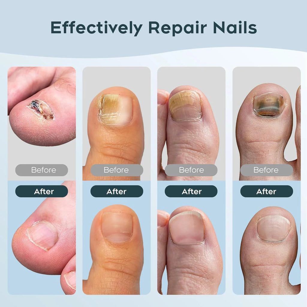New Household Fungal Nail Laser Device – Toenail Fungus Repair & Nail Care Tool